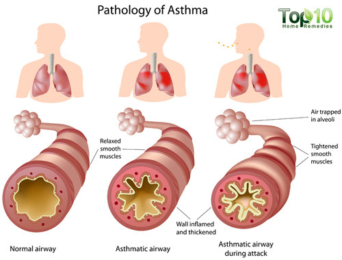 asthma anatomy