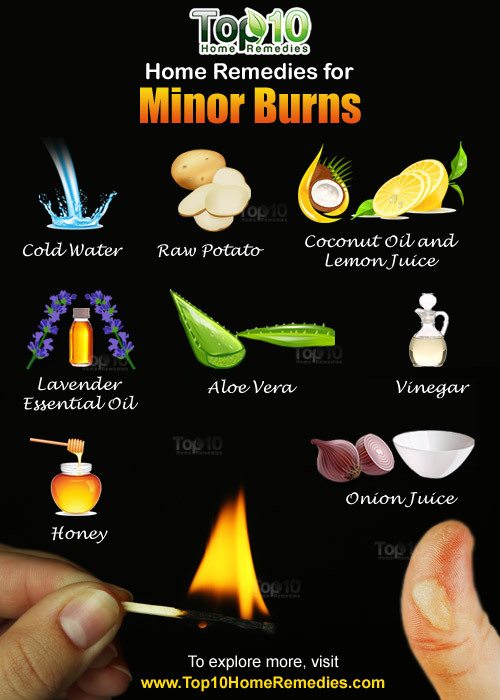 burn treatment home remedy