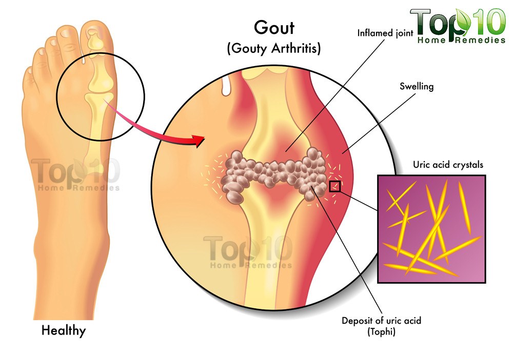 What are some common symptoms of gout?