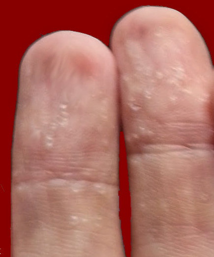 Peeling Skin On Hands & Fingertips - Yogawiz
