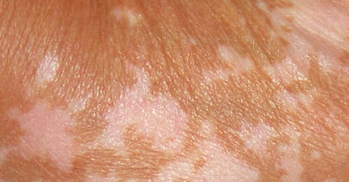 How to Get Rid of White Patches on Skin, Vitiligo
