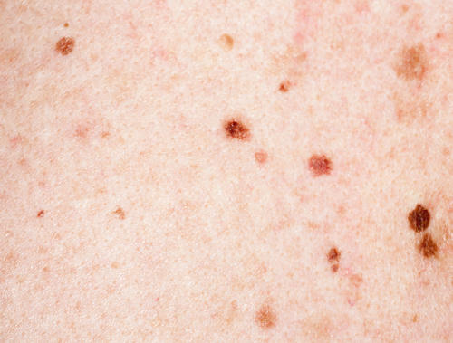 little brown spots on skin
