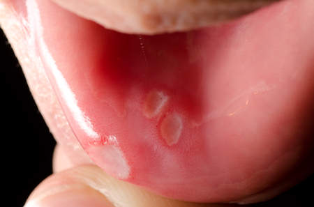 Are there any medicinal treatments for a sore tongue?
