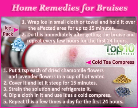 Bruises How To Get Rid Of