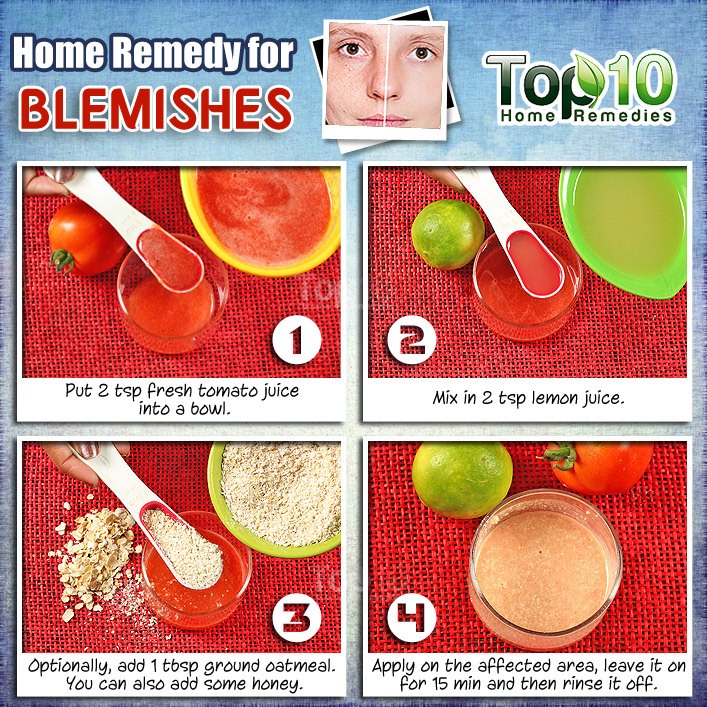 How do you get rid of acne in 2 weeks with a home remedy?