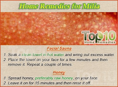 What are some remedies for milia?