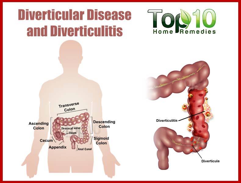 What foods are recommended for someone with diverticulitis?