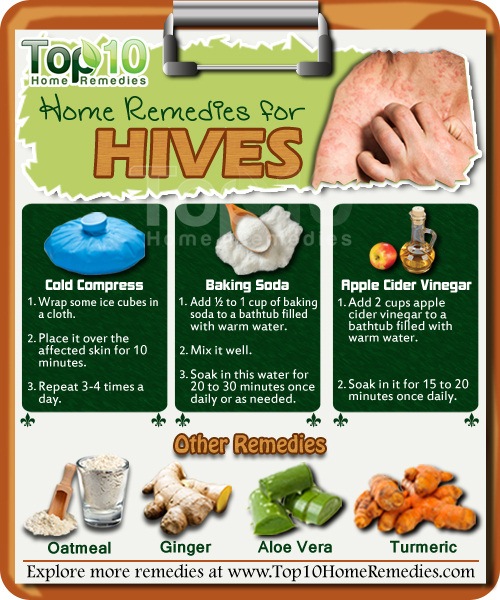 Home Remedies For Hives Top 10 Home Remedies