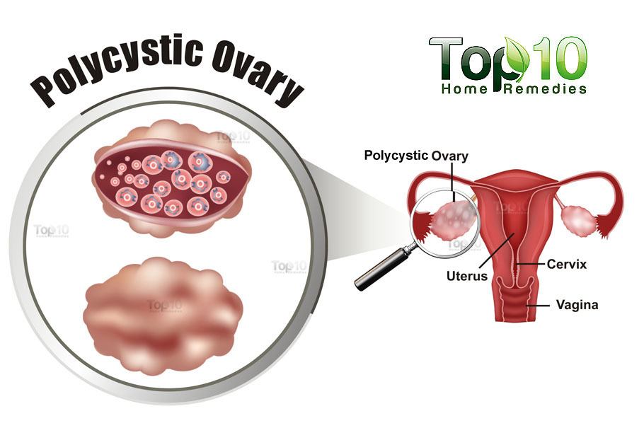 polycystic ovarian syndrome acne treatment #10