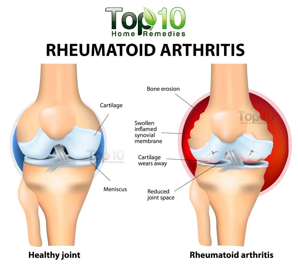 Are there any effective natural treatments for arthritis?