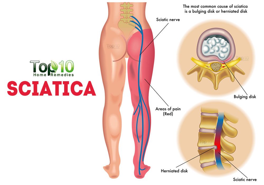 What are some tips for relieving left hip and leg pain due to sciatica?