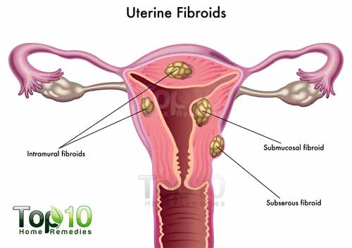 uterine-fibroids-500