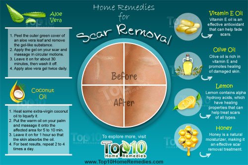 home remedies for scar removal