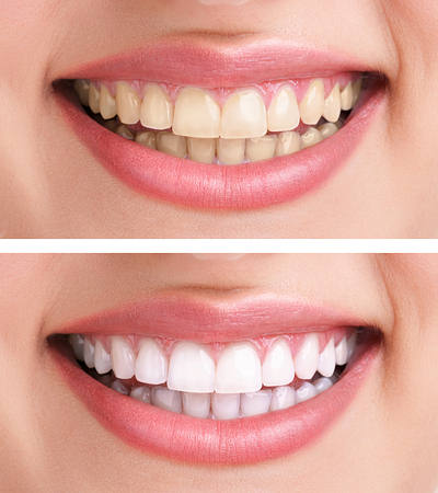 whiten teeth