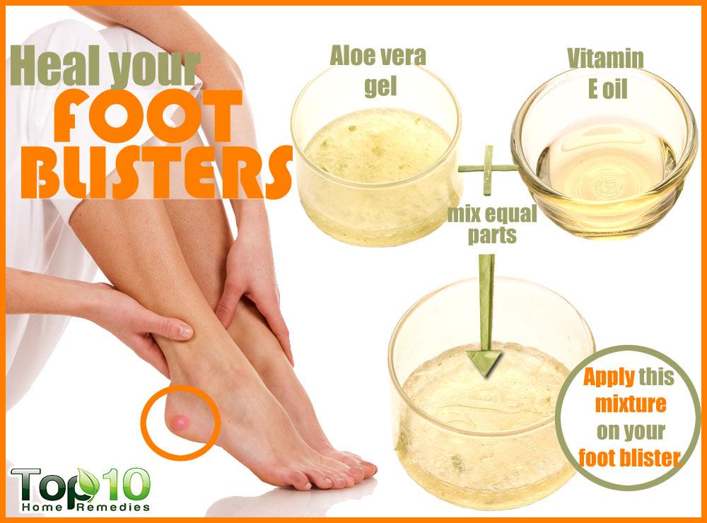 What home remedies are used to treat gout?