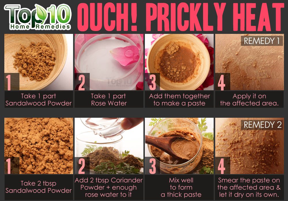 Prickly heat rash: symptoms, causes, treatments, prevention