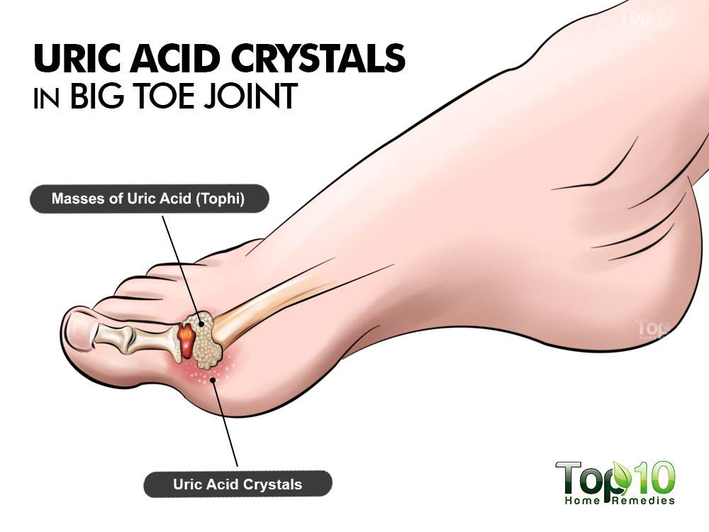 What are some causes of high uric acid levels in the body?