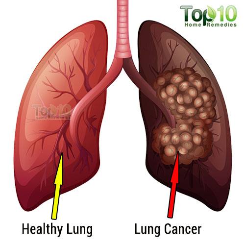 What are the symptoms of advanced lung cancer?