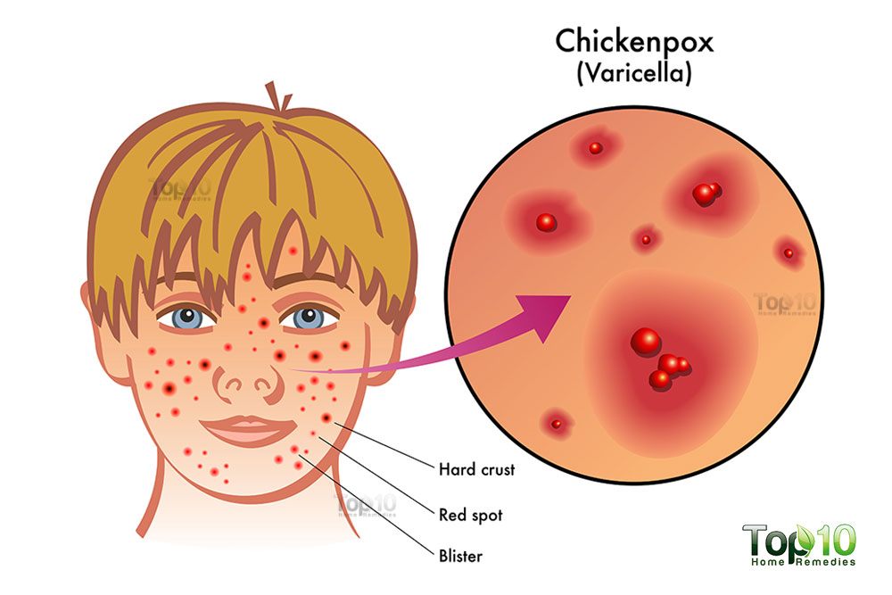 chicken pox rashes