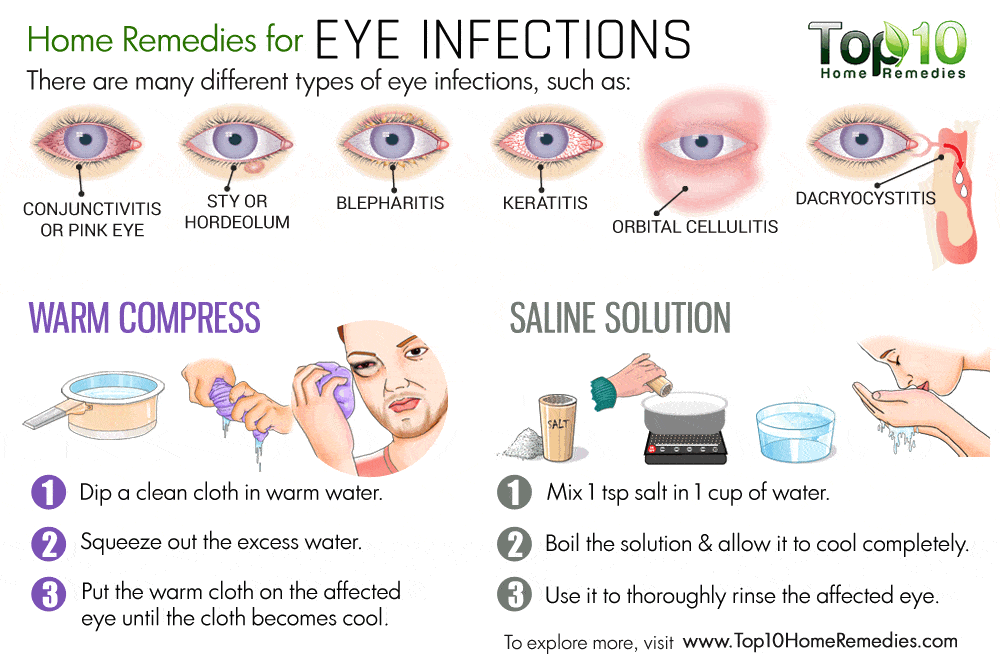 Home Remedies for Eye Infections  Top 10 Home Remedies