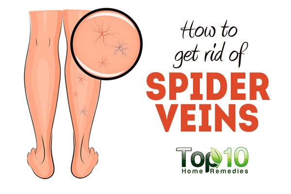 How To Get Rid Of Spider Veins On Legs