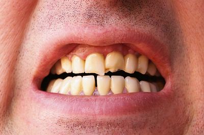 Tips For Good Dental Care