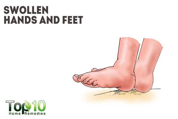 Swollen Hands And Feet In Babies 37