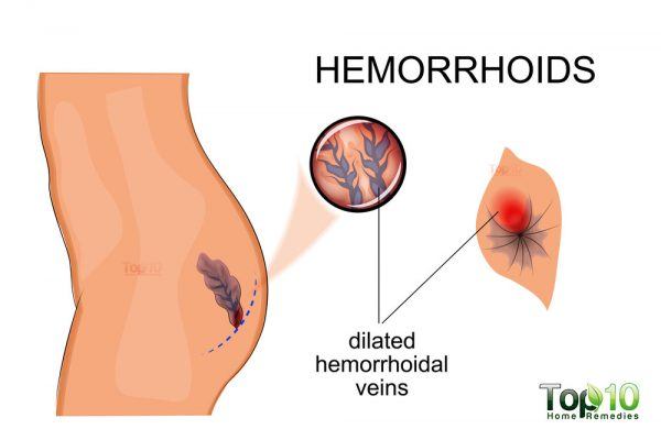 hemorrhoids diagram