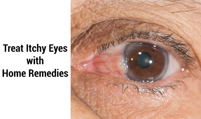 Home Remedies for Itchy Eyes | Top 10 Home Remedies