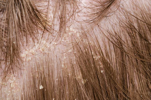 dandruff