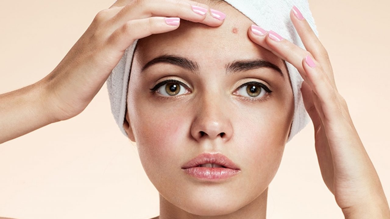 anti acne home remedies