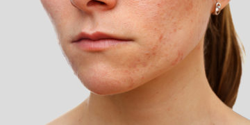 Home remedies for eczema scars