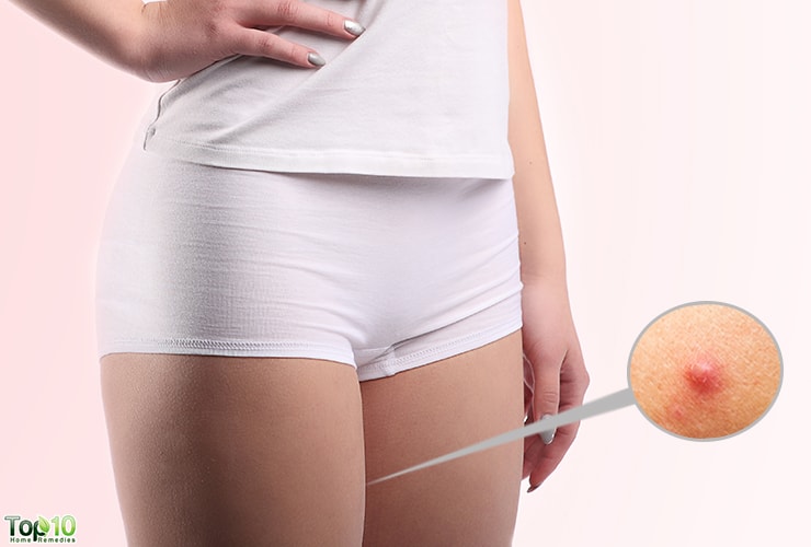 How To Get Rid of Boils on Inner Thigh | Top 10 Home Remedies