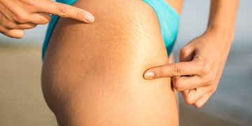 How to Get Rid of Stretch Marks Fast