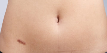 Home remedies for Keloids