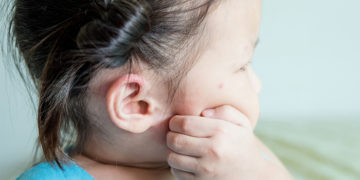 Home remedies for mosquito bites