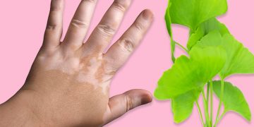 How to Get Rid of White Patches on Skin, Vitiligo