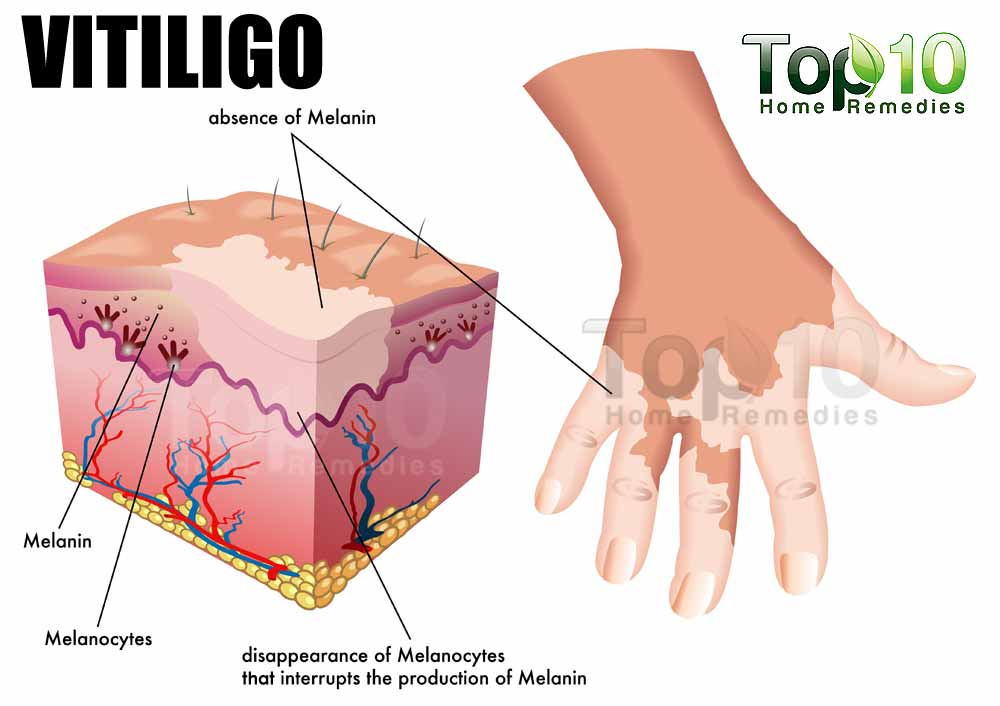 Image result for vitiligo