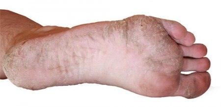 foot skin cracking and peeling