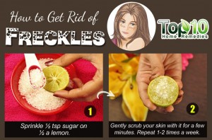 freckles home remedy