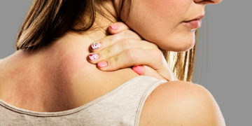 Home Remedies for Dermatitis