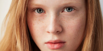Home remedies to get rid of frickles