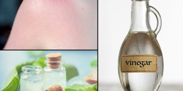 How to Get Rid of Sunburn Blisters