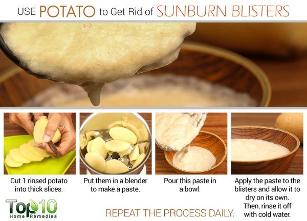 potato for sunburn blisters