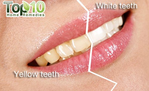 yellow teeth