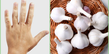 Home remedies for warts