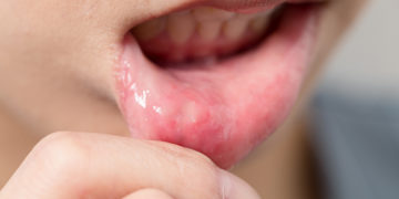 Home remedies for mouth ulcers