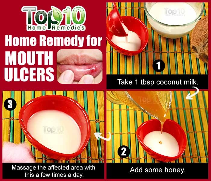Home Remedies for Mouth Ulcers | Top 10 Home Remedies