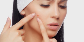 Home remedies for pimples
