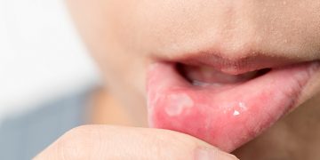 how too get rid of canker sore fast